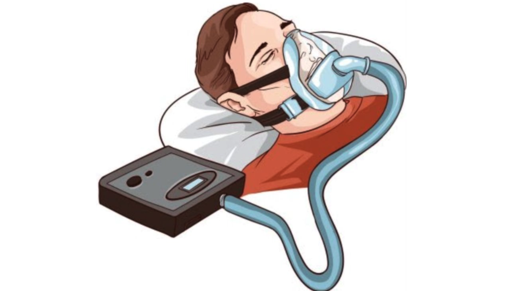 CPAP 無法有效改善 OSA 患者的會厭塌陷，但可使吸氣流量正常化，不論會厭是否持續塌陷。
