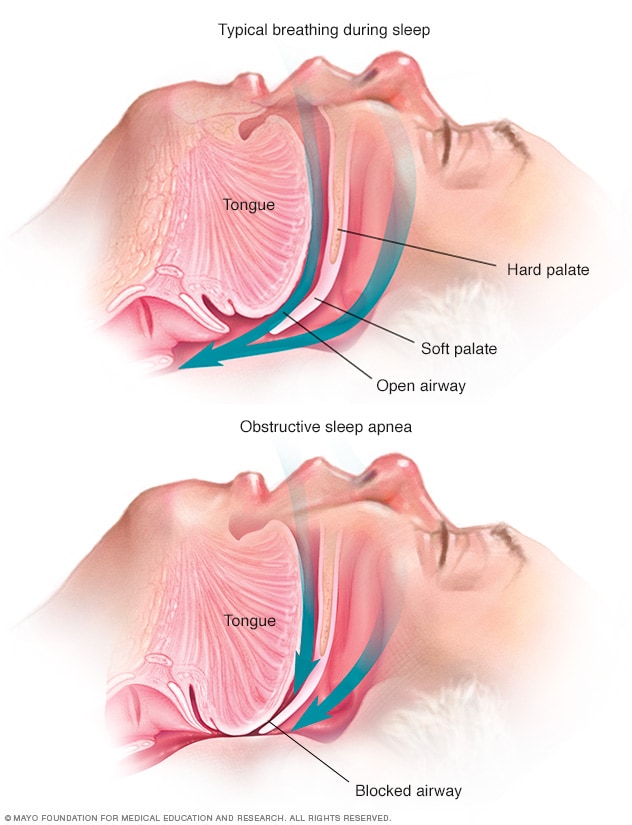 睡眠呼吸中止症, Sleep apnea,阻塞型睡眠呼吸中止症, OSA